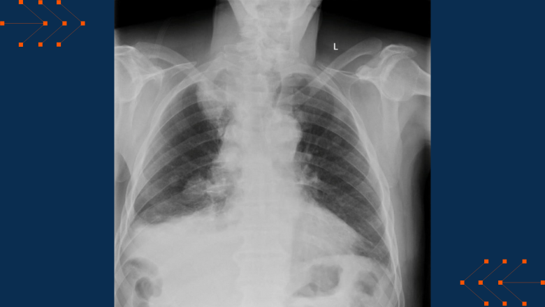 chest x-ray new banner