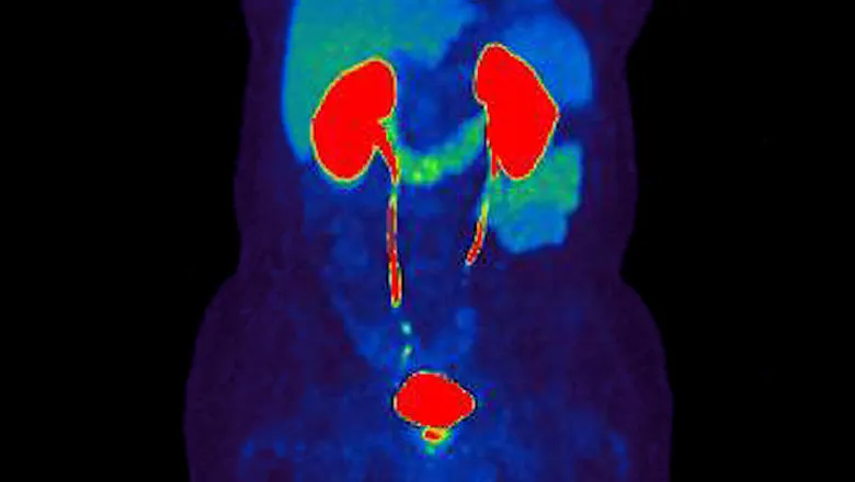 prostate cancer diagnosis PET Scan