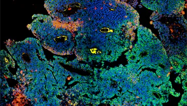 Cancer Immunology & Immunotherapy