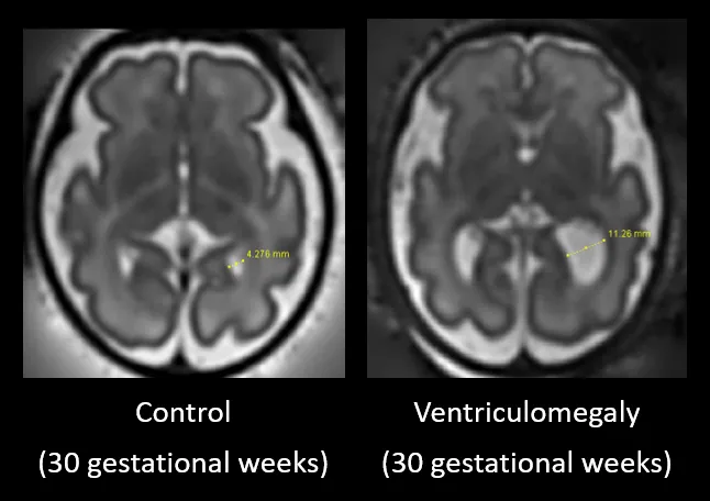 Ventriculomegaly on MRI