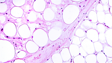 Obesity, Type 2 Diabetes & Immunometabolism