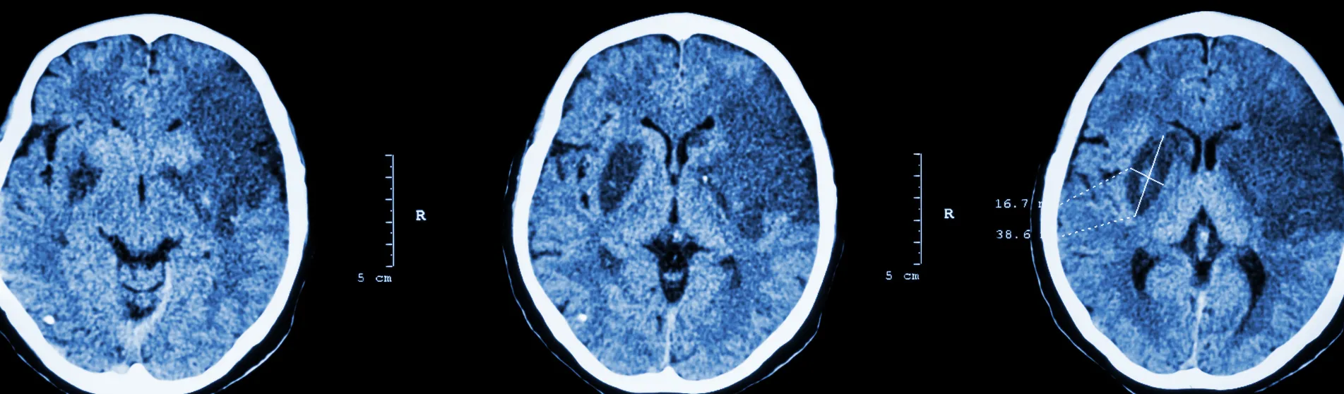 Ischemic stroke