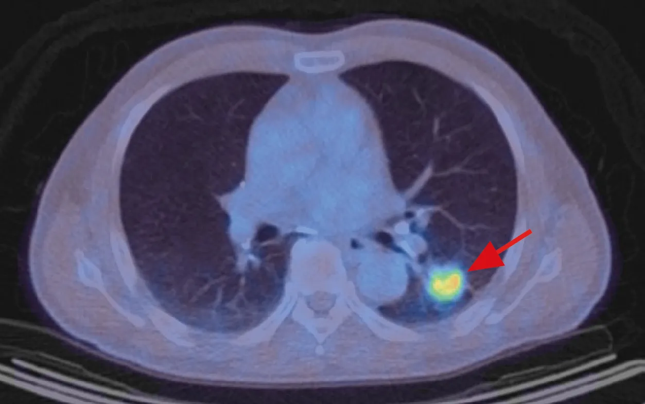Lung cancer FSPG