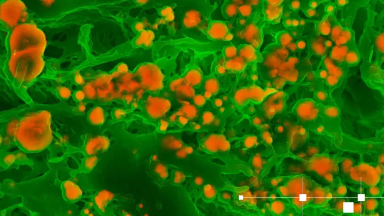 microcalcification in soft tissue