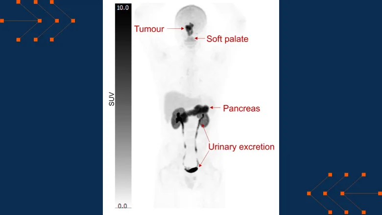 The image shows normal physiological uptake of 18F-FSPG in the soft palate, liver, and pancreas with renal excretion