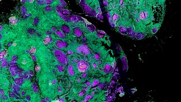 Cancer Bioinformatics