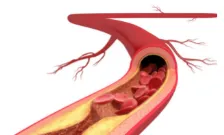 Ferro lab project 1 atherosclerosis