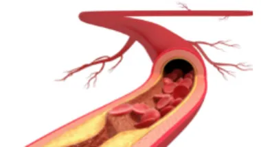 Ferro lab project 1 atherosclerosis