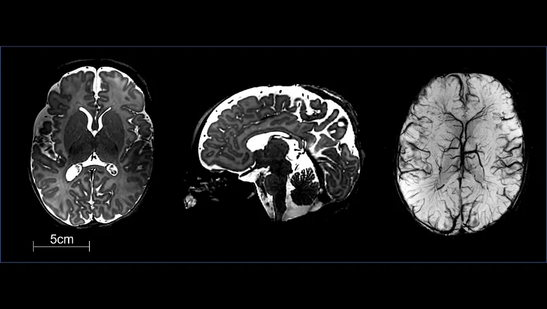 baby-brain-scan-anonymised