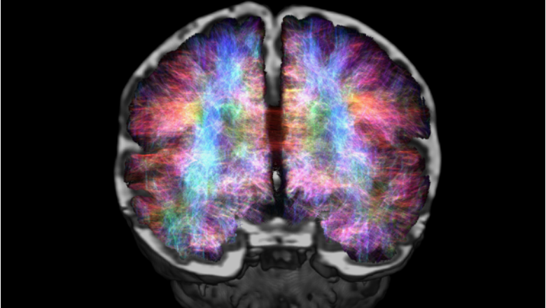 Featured image shows Diffusion Imaging of the neonatal brain. 