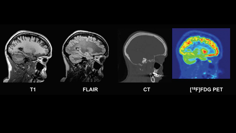 New Database Of Healthy Adult Human Brain Pet Mri And Ct Images Is Now Available For Research