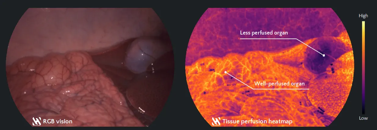 Video-rate visualisation of conventional red/green/blue alongside quantitative tissue perfusion heatmap, demonstrating relative tissue oxygenation differences in between intra-abdominal organs during general surgery. 