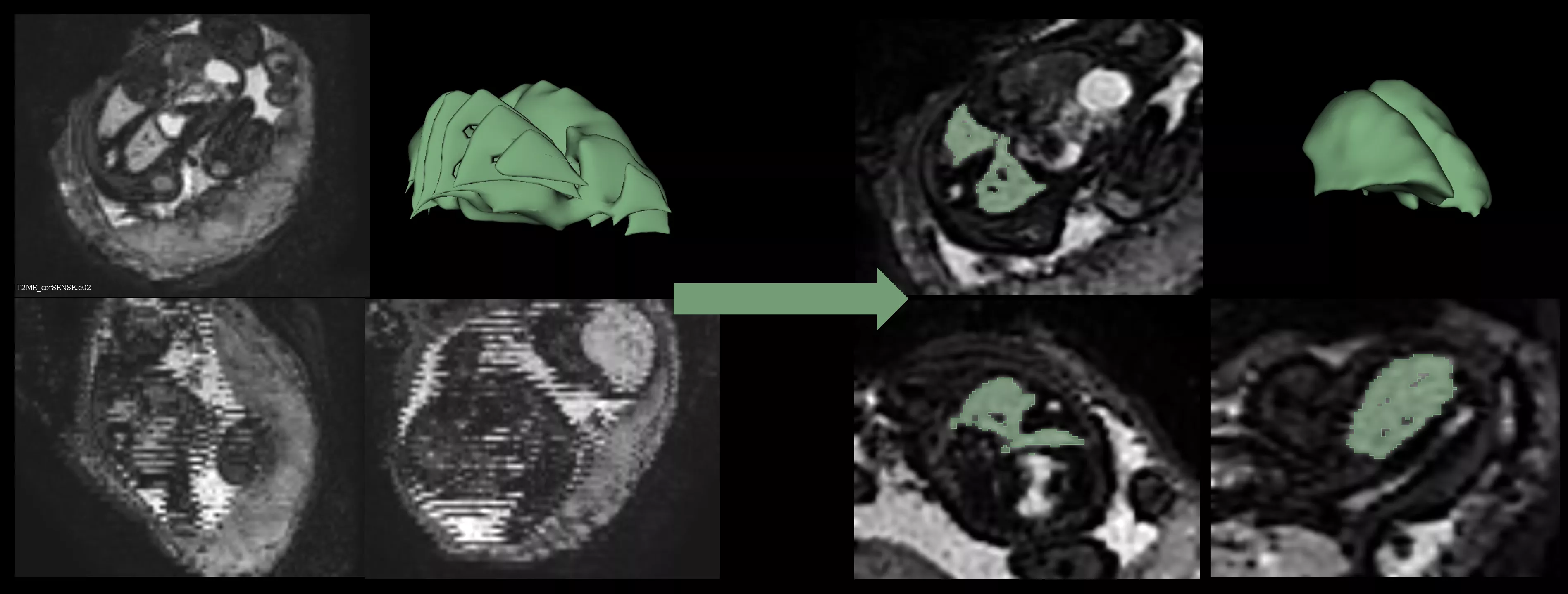 Images of a baby’s lung during pregnancy which have been corrected for fetal motion. The pictures on the left show the original data and on the right after the team corrected for movement.