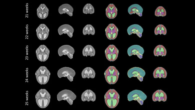 Lucas-Fidon-fetal-brain-atlas_resized