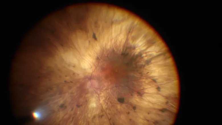 retinal fundus