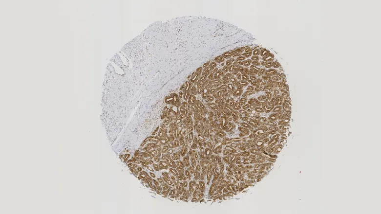 RNA-binding proteins (cancer)