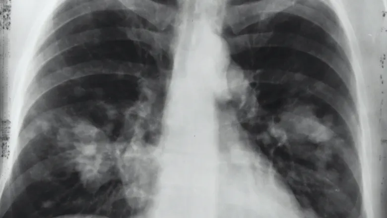 lung-covid