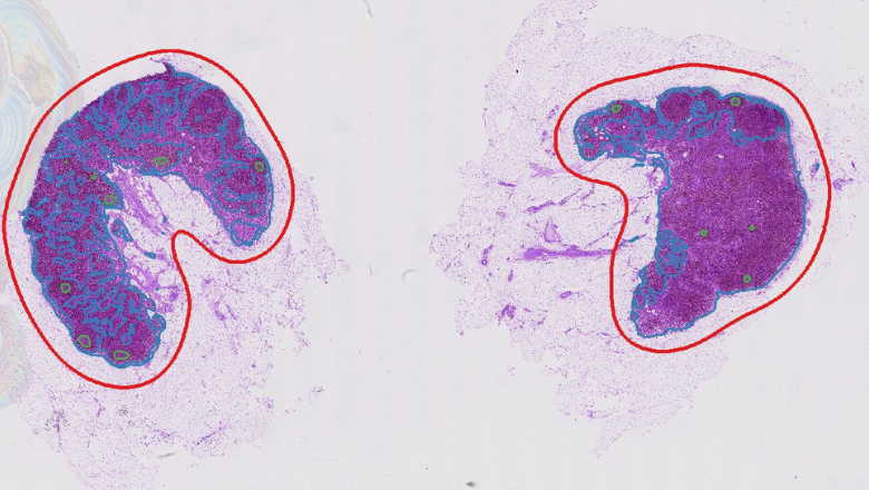 ai-lymph-nodes