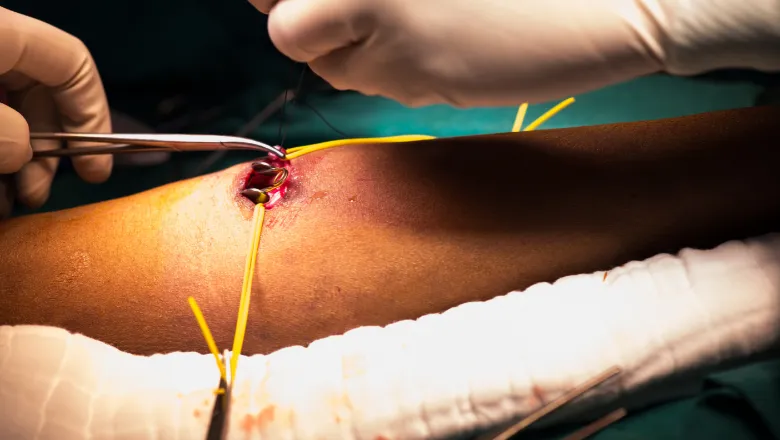 arteriovenous fistula main