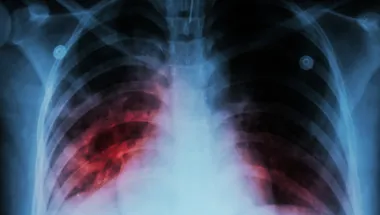 Pulmonary Obstruction