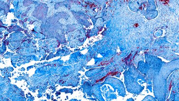 Cancer Imaging