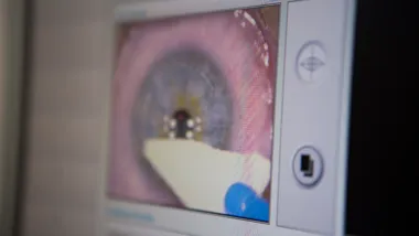 laser surgery