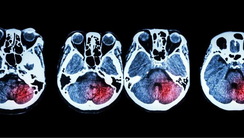 Stroke Research Group thumbnail 780×440