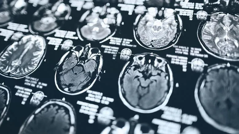 Brain scans on a screen