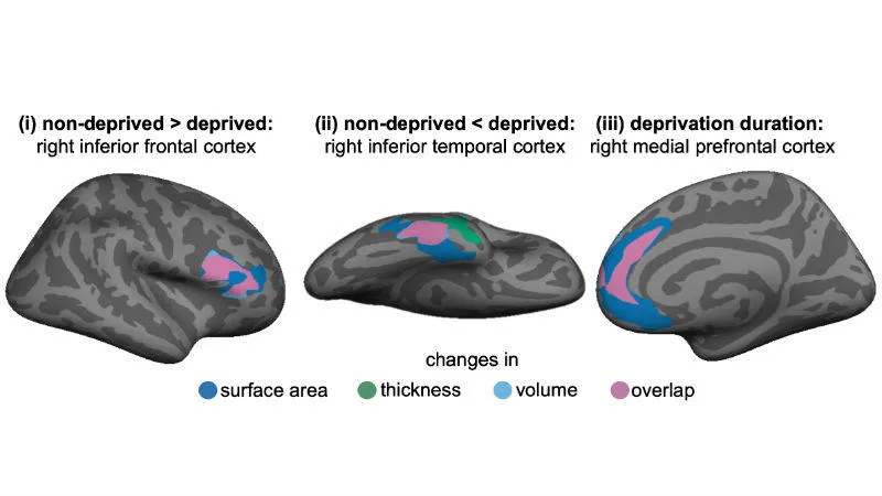 Local differences in adult brain structure associated with early deprivation