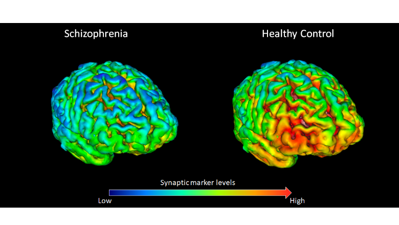 new research on schizophrenia suggests that