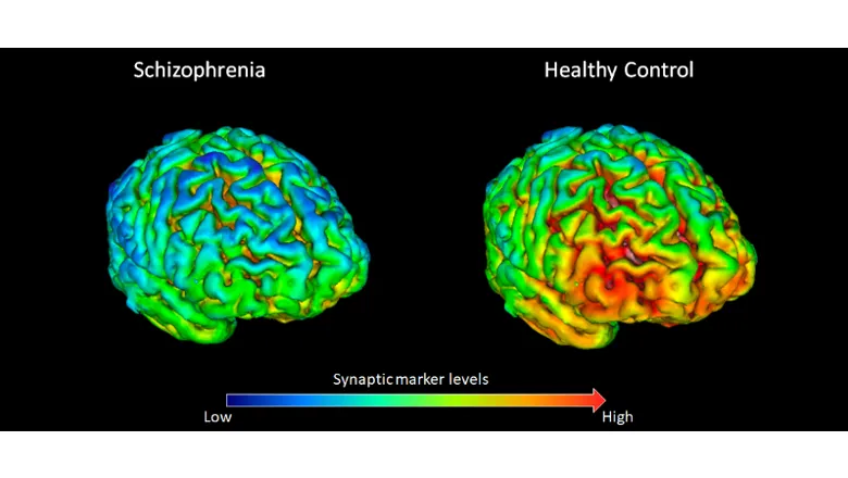 Schizophrenia and healthy controls, synaptic marker levels