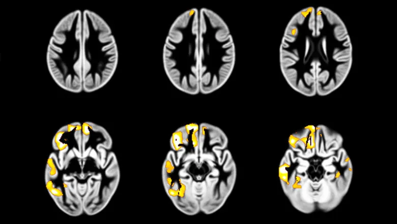 Brain regions where a decrease in grey matter between the ages of 14 and 19 years is associated with an increase in drunkenness frequency between 14 and 19 years