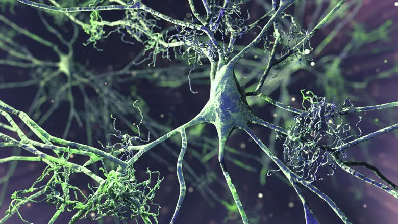 Neuroscience Nerve cells affected by Alzheimer's disease iStock-2212890390