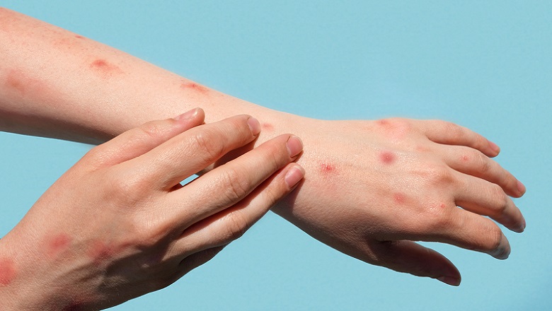 image of a rash on a person's hands and arms 