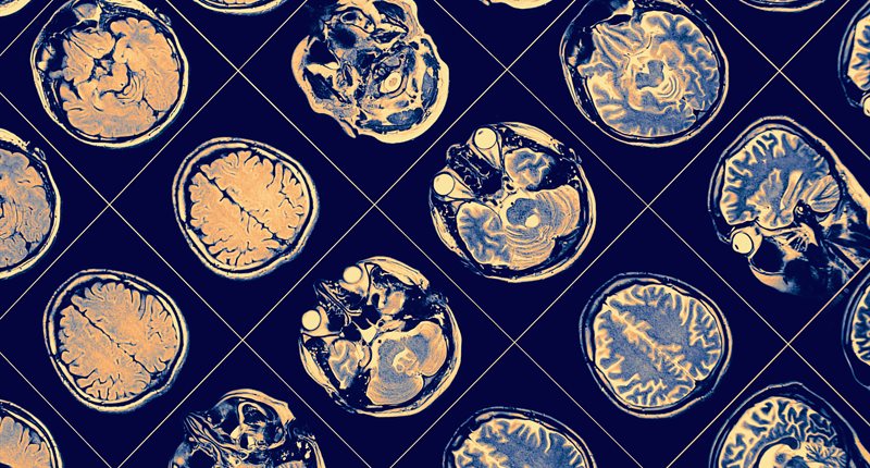 brain scan