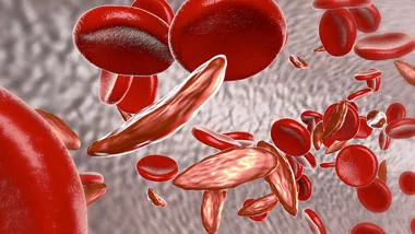sickle-cell-blood-780x450