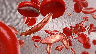 sickle-cell-blood-780x450