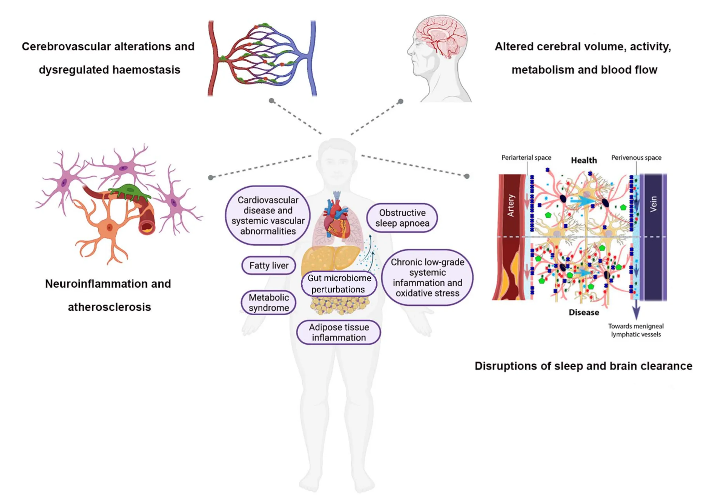 Schematic diagram summarising factors, contributing to the pathogenesis of NAFLD and possibly increasing the risk of development and progression of neurodegenerative diseases.