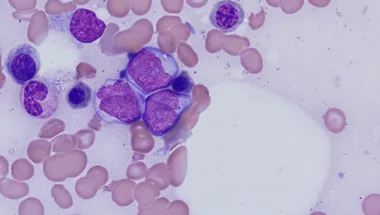 acute myeloid leukemia 780x450