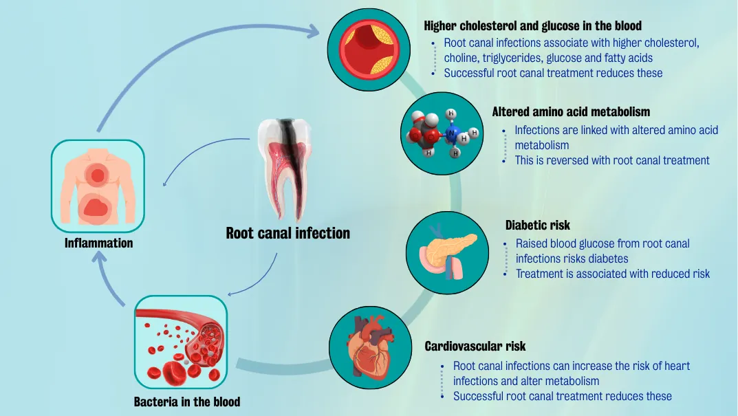 Root canal infection infograph