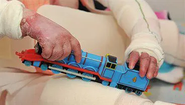 Clothing designed for a rare skin condition